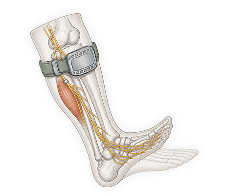 Gait-adaptive control system and method for wearable drop foot electrical stimulators. Taiwan Patent, Granted (2018).